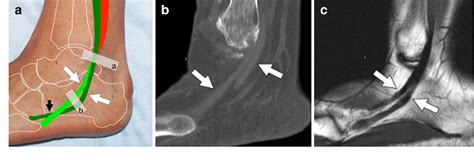 High Resolution Us And Mr Imaging Of Peroneal Tendon Injuries My Xxx