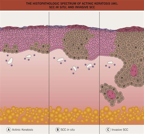 Actinic Keratosis Basal Cell Carcinoma And Squamous Cell Carcinoma