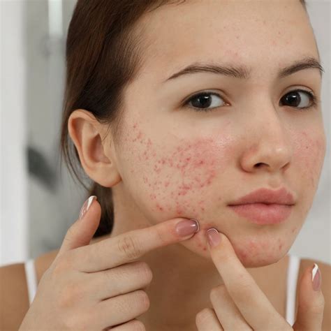 Acne And Congestion Treatment Melbourne Beauty Bliss Skin