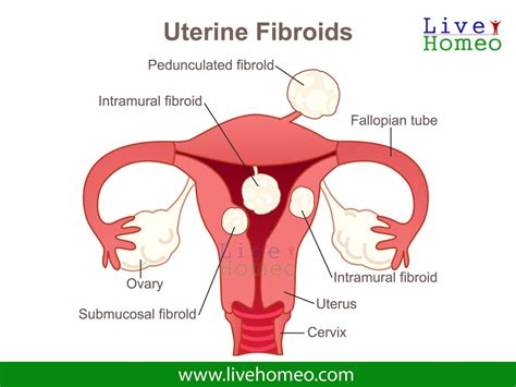 About Uterine Fibroids Best Homeopathy Treatment For Uterine Fibroids