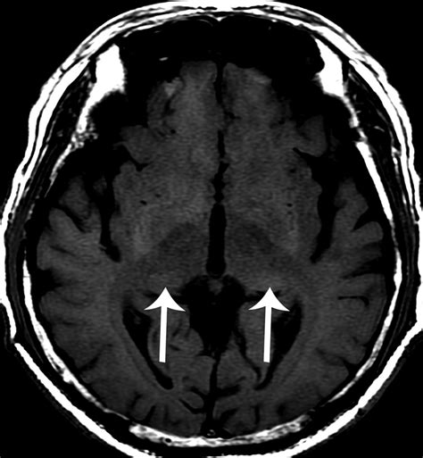 Brain Mr Imaging Findings Of Cardiac Type Fabry Disease With An Ivs4