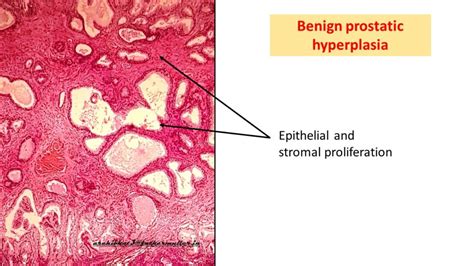 Benign Prostatic Hyperplasiabph Nodular Hyperplasia Of Prostate