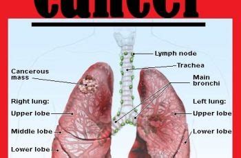 Stage iva and stage ivb. Lung Cancer With Copd Life Expectancy - Cancer News Update