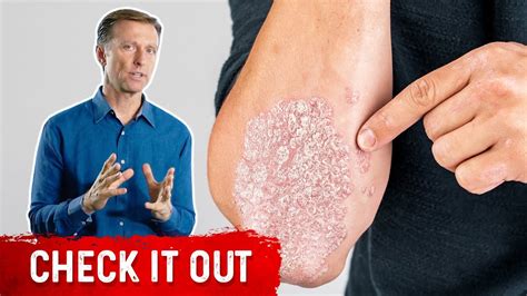 A Great Psoriasis Remedy Youtube