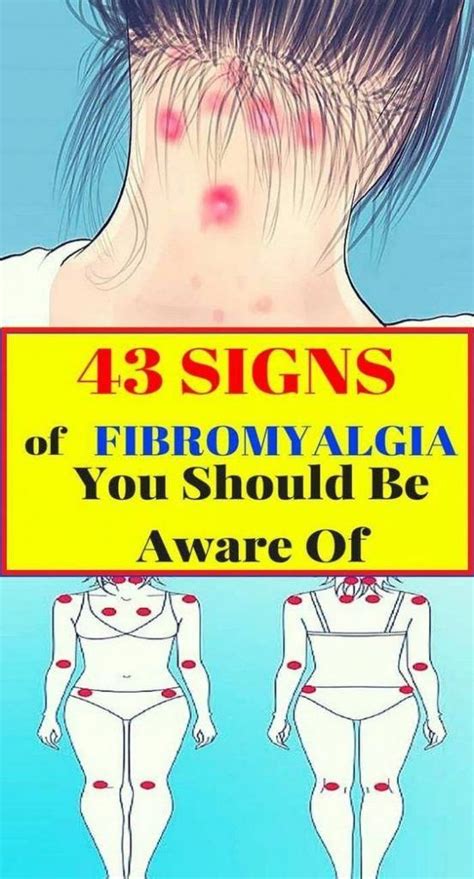 43 Signs Of Fibromyalgia You Should Be Aware Of Signs Of Fibromyalgia Fibromyalgia What