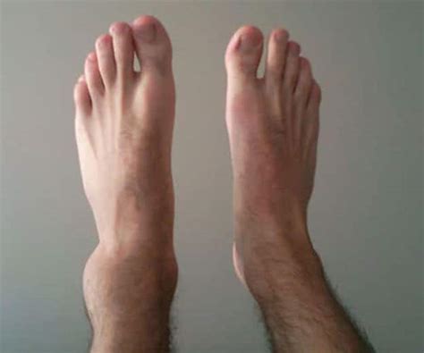 A Sprained Ankle Causes Symptoms Types Grades Treatments