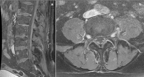 A Sagittal And B Axial T1 Weighted Mri With Gadolinium