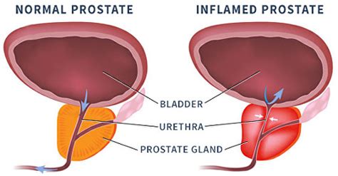 Benign Prostatic Enlargement Bpe The Urology Partnership