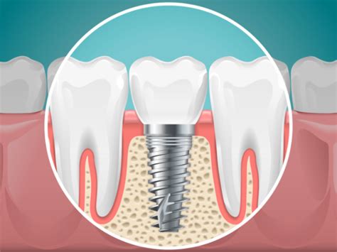 Understanding The Process Of Dental Implant Surgery Fabrioberto