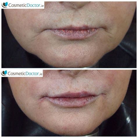Before And After Lip Augmentation Cosmetic Doctor Dublin Cosmetic