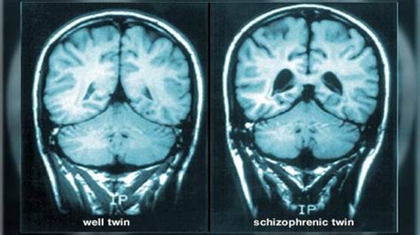 Schizophrenia Facts Symptoms And Causes Education Today News