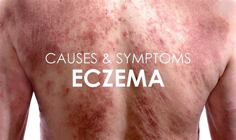 Eczema Causes Symptoms Treatments Premier Clinic