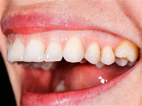 White Gums Around Teeth After Brushing Teethwalls
