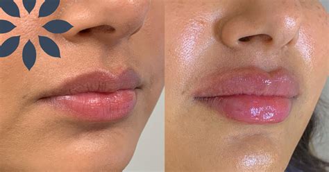 Lip Filler Before And After Pilopix