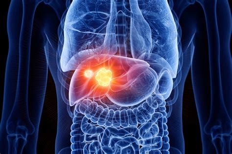 Based on symptoms alone, it may be difficult to detect liver cancer early, when it's often easier to treat. Can You Have Liver Cancer and Not Know It? | Roswell Park ...