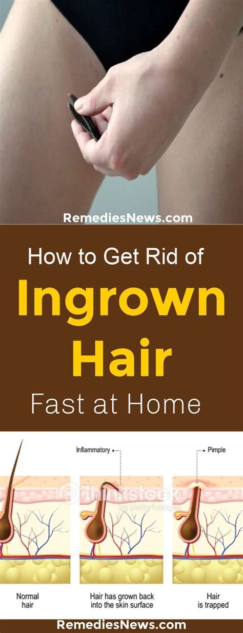 How To Get Rid Of Ingrown Hair Fast At Homestop Removing The Hair In