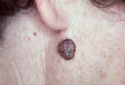 SKIN DISEASE TYPES Seborrheic Keratosis Skin Disease Type