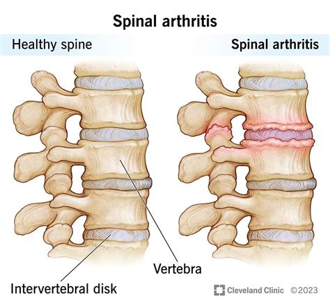 Spinal Arthritis Symptoms And Treatment