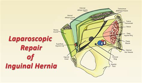 Laparoscopic Repair Of Inguinal Hernia Healthcare