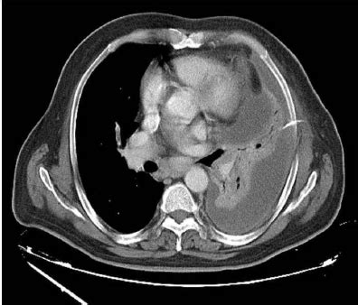 Large pleural effusions, s/p thoracentesis with pleural fluid suggestive of transudative process. CT showed loculated massive pleural fluid, multiple ...