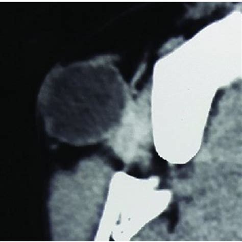 Ct Scan Of Right Cheek Showing Well Defined Hypodense Lesion