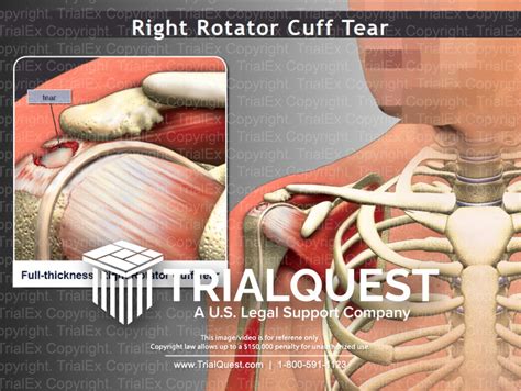 Right Rotator Cuff Tear Trialquest Inc