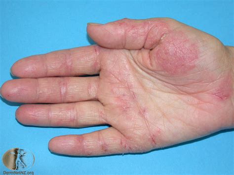 Eczema Hands Treatment Dorothee Padraig South West Skin Health Care