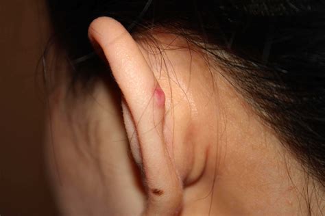How To Remove Keloid On Ear Paradox