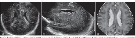 Pdf Neonatal Head Ultrasound Systematic Approach To Congenital