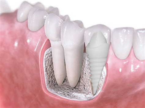 The prices for one to three replacement to enquire about low cost implants with the uk's leader in the field, get in touch with the experts at perfect profiles dental implant centres now on. How much does a zirconium tooth implant cost? - Quora