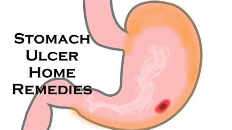 How To Cure Stomach Ulcers At Home