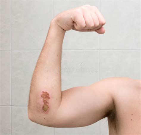 Scraped Elbow 1 Stock Photo Image Of Pain Scratch Skin 6777262