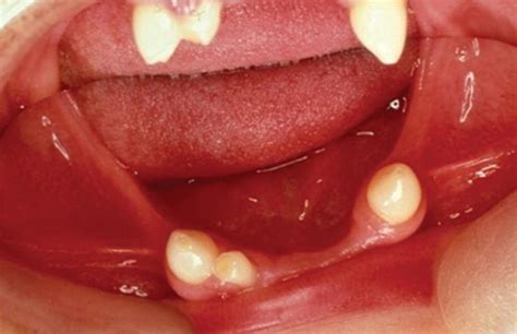 Etiology And Pathology Of Teeth Disturbances Pocket Dentistry
