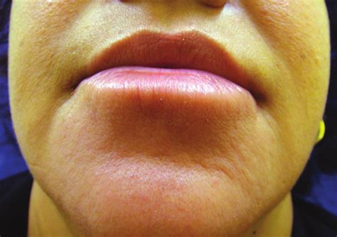 Erythematous And Edematous Plaque On Chin And Lower Lip Skin Looks