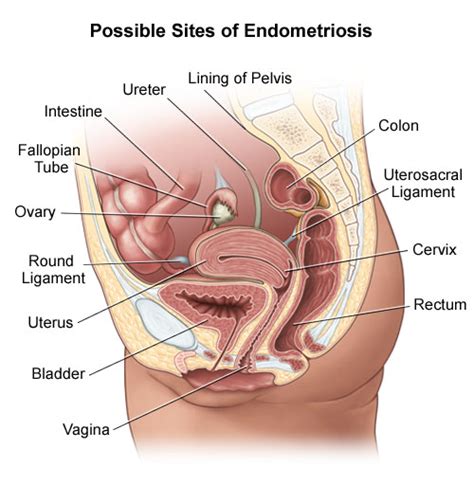 Endometriosis Overview Newton Wellesley Hospital