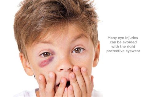 How To Reduce The Swelling Of A Black Eye Respectprint22