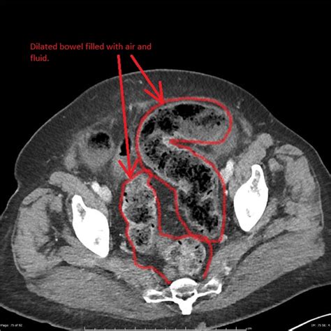 Ischemic Colitis Ct Wikidoc