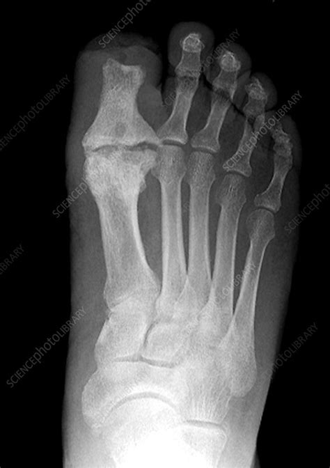 Foot Amputation Resulting From Diabetes Stock Image M1400429