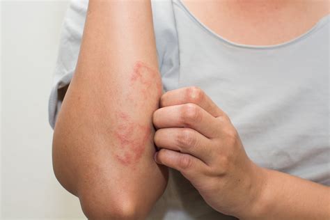 What Does Eczema Look Like Signs To Never Ignore The Healthy