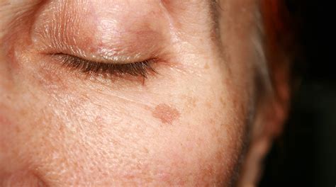 Sun Damage And Brown Spots Lebo Skin Care