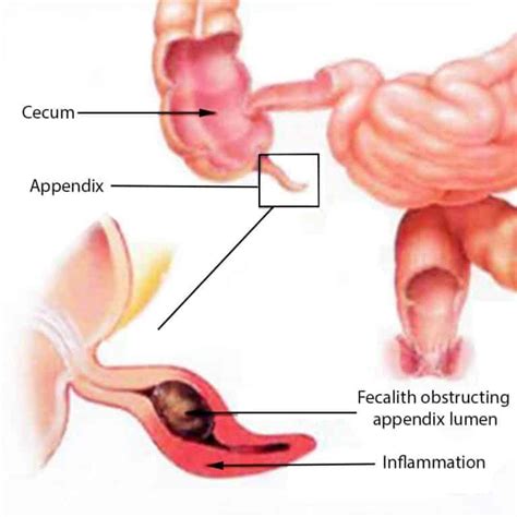 What Is Appendicitis Diagnosis And Treatment Medfog