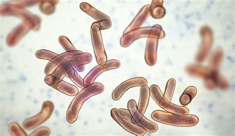 Cholera Signs Symptoms And Treatment Au