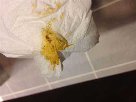 Maybe you would like to learn more about one of these? Worm on toilet paper On CureZone Image Gallery