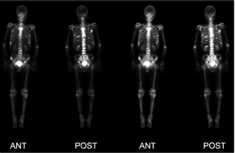 Anterior And Posterior Bone Scanning Using 99m Tc Mdp Images Of A