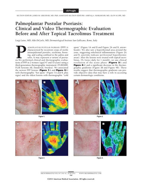 Palmoplantar Pustular Psoriasis Clinical And Video Thermographic