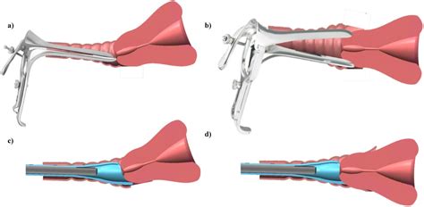 A Novel Versatile Speculum Free Callascope For Clinical Examination