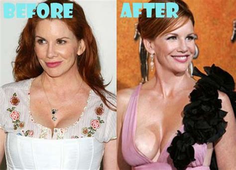 Melissa Gilbert Plastic Surgery Before And After Photos Lovely
