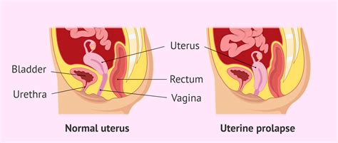 Uterine Prolapse Uterus Vagina Pelvic Floor Muscles Bladder Patient