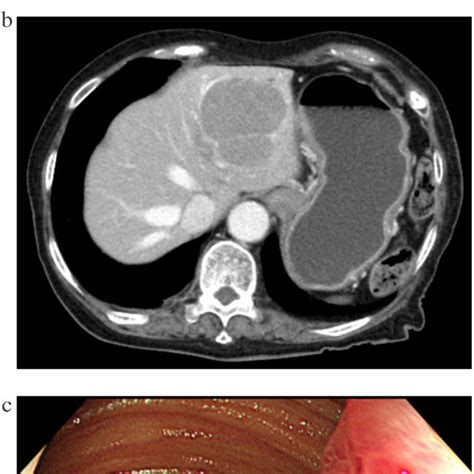 A Findings On Contrast Enhanced Computed Tomography Intussusception