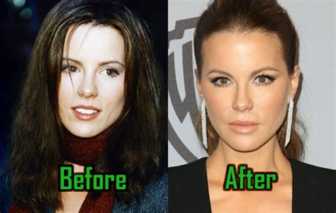 Kate Beckinsale Plastic Surgery: Nose Job, Botox, Before ...